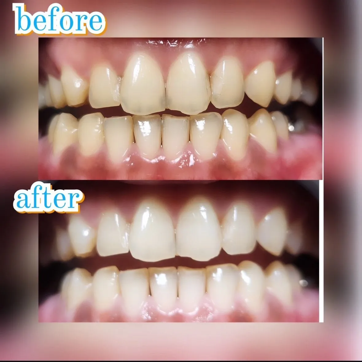 美歯口セルフホワイトニング