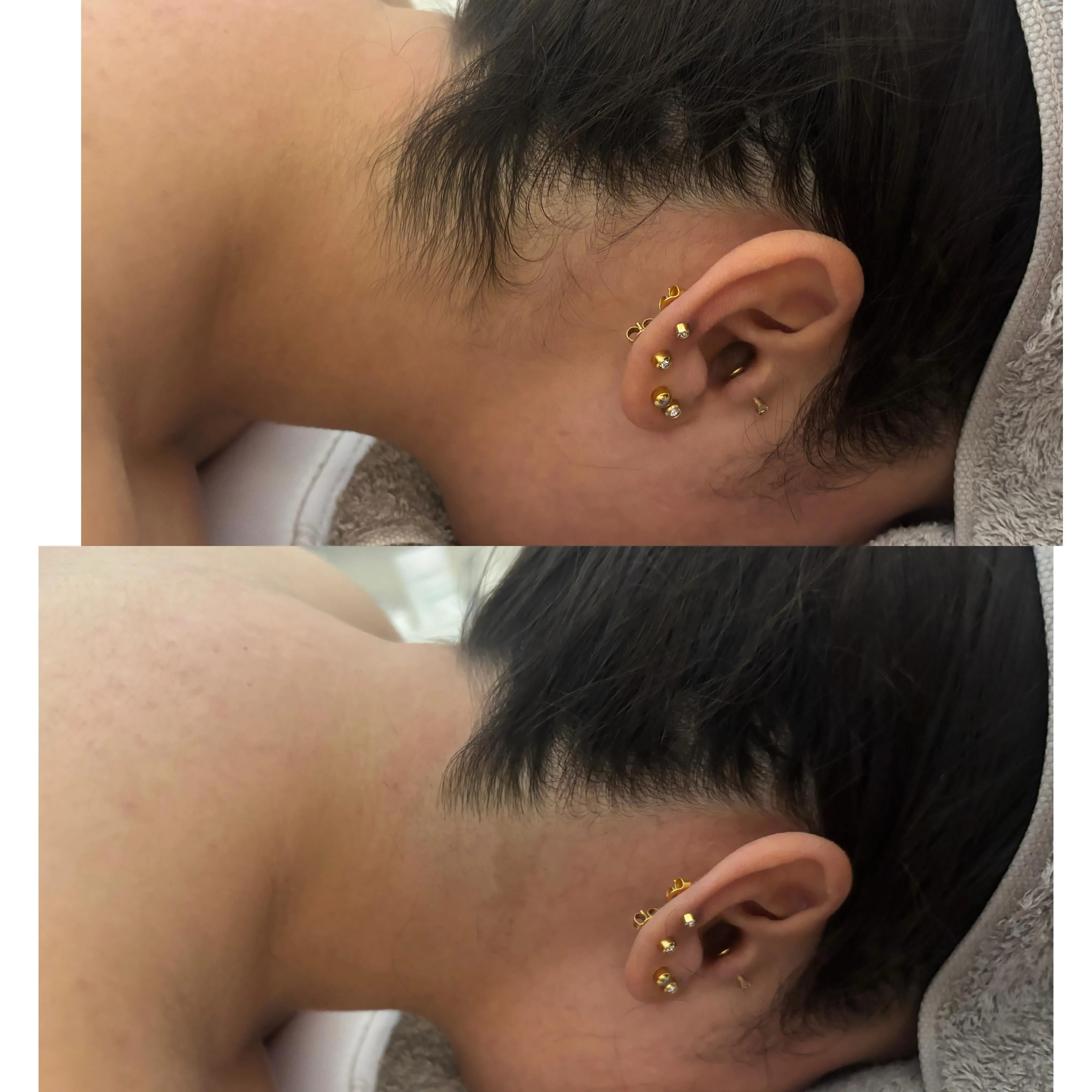 ✨うなじ脱毛 Before→After✨